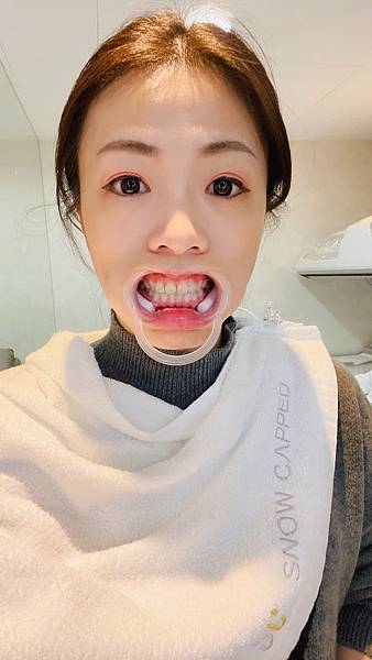 snow capped牙齒美白 (6).jpg snow capped牙齒美白 (6).jpg