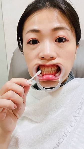 snow capped牙齒美白 (8).jpg snow capped牙齒美白 (8).jpg