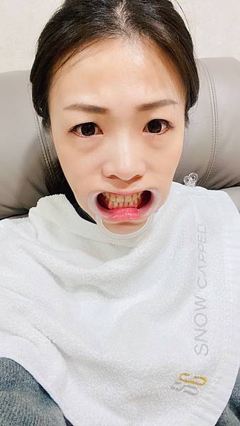 snow capped牙齒美白 (10).jpg snow capped牙齒美白 (10).jpg