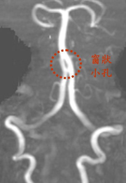 暈眩