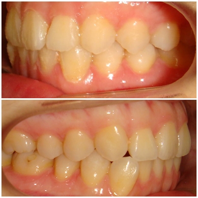 牙套纪录(侧面齿列)