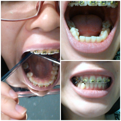 左图是已经拔掉牙齿的照片