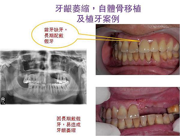 自體骨移植及植牙案例.1