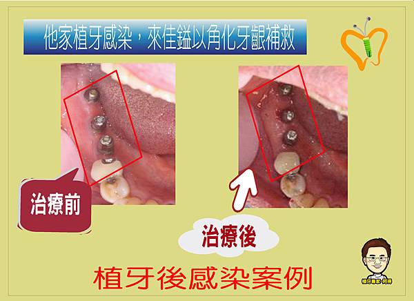 角化牙齦案例.5.JPG