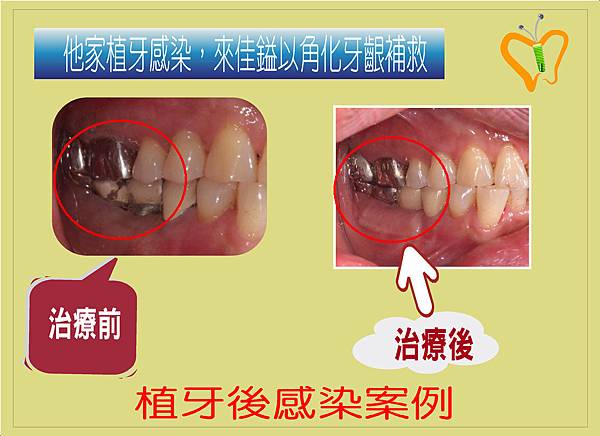 角化牙齦案例.4.JPG