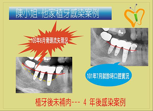 角化牙齦案例.2.JPG