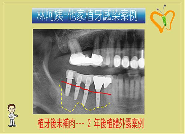角化牙齦案例.3.JPG