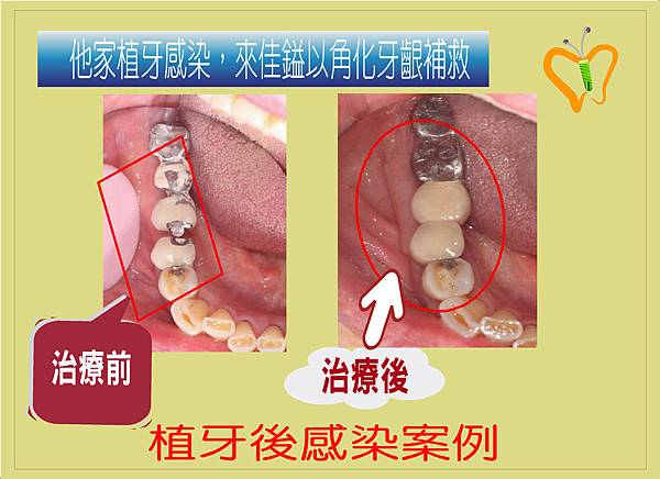 角化牙齦案例.6.JPG