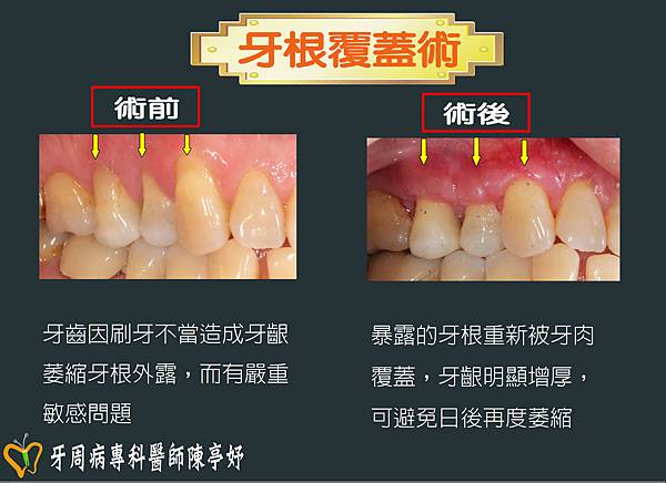 牙根覆蓋術.JPG