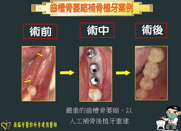 齒槽骨萎縮.1.JPG