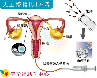 iui人工授精過程.jpg