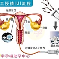 iui人工授精過程.jpg