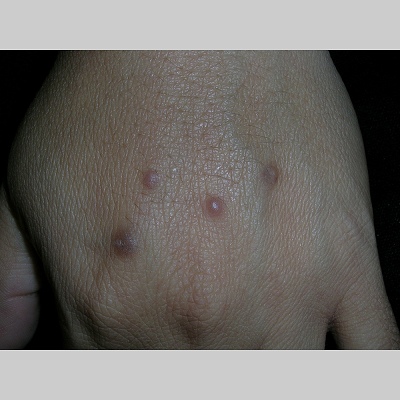 prurigo-nodularis-hand42yoHW