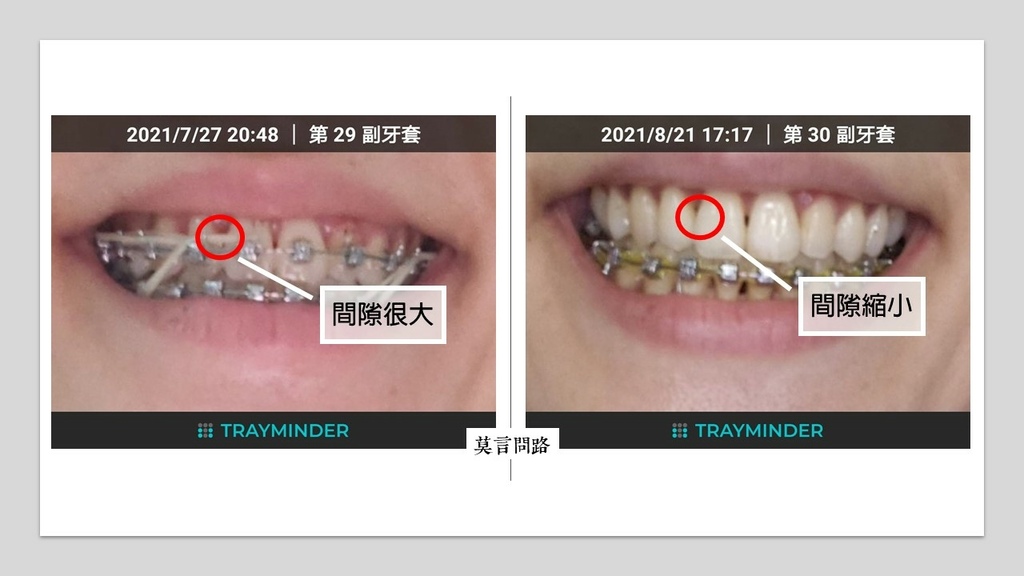 鋼牙莫言的齒列矯正紀錄(8) - 20210821 拆除上排矯正器、黏維持器3.jpg