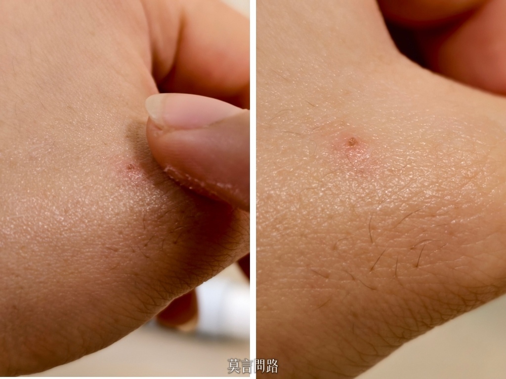 「ProtoPlus普特緩潔淨慕斯、Procto-eze普治緩保護軟膏」針對私密處、傷口照護、痔瘡、紅臀、敏感肌、異位性皮膚炎、更年期會陰症狀等日常保養 (14).jpg 「ProtoPlus普特緩潔淨慕斯、Procto-eze普治緩保護軟膏」針對私密處、傷口照護、痔瘡、紅臀、敏感肌、異位性皮膚炎、更年期會陰症狀等日常保養 (14).jpg