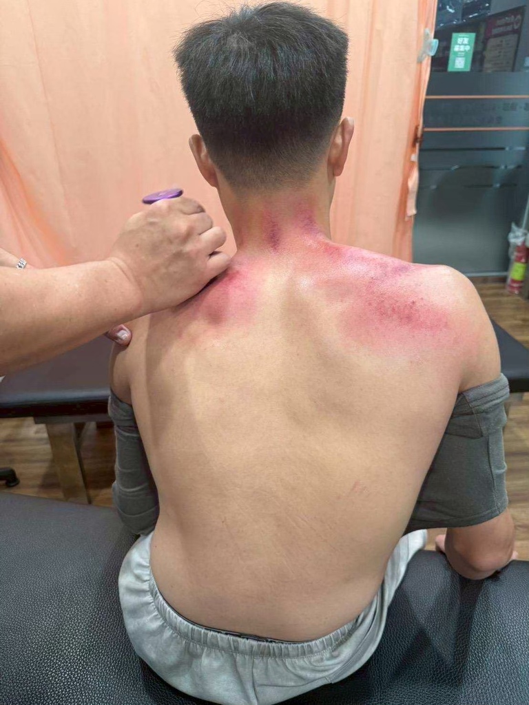 台南永康中醫｜親身體驗【健恩中醫診所】艾草溫罐療法｜解決肩頸