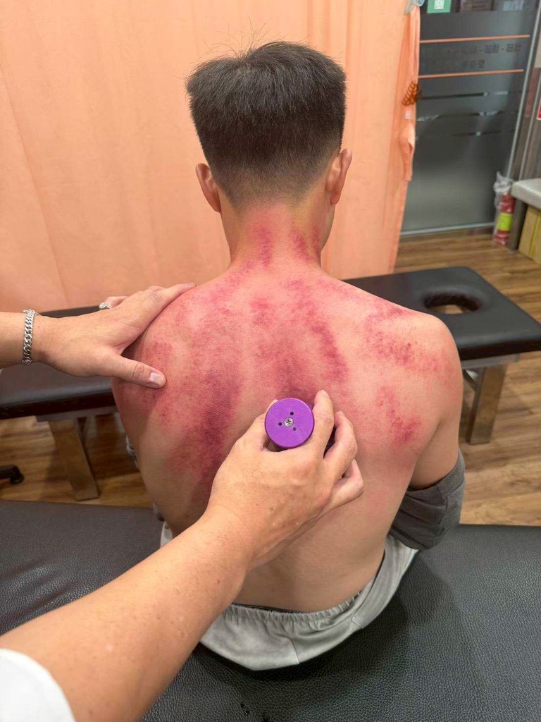 台南永康中醫｜親身體驗【健恩中醫診所】艾草溫罐療法｜解決肩頸