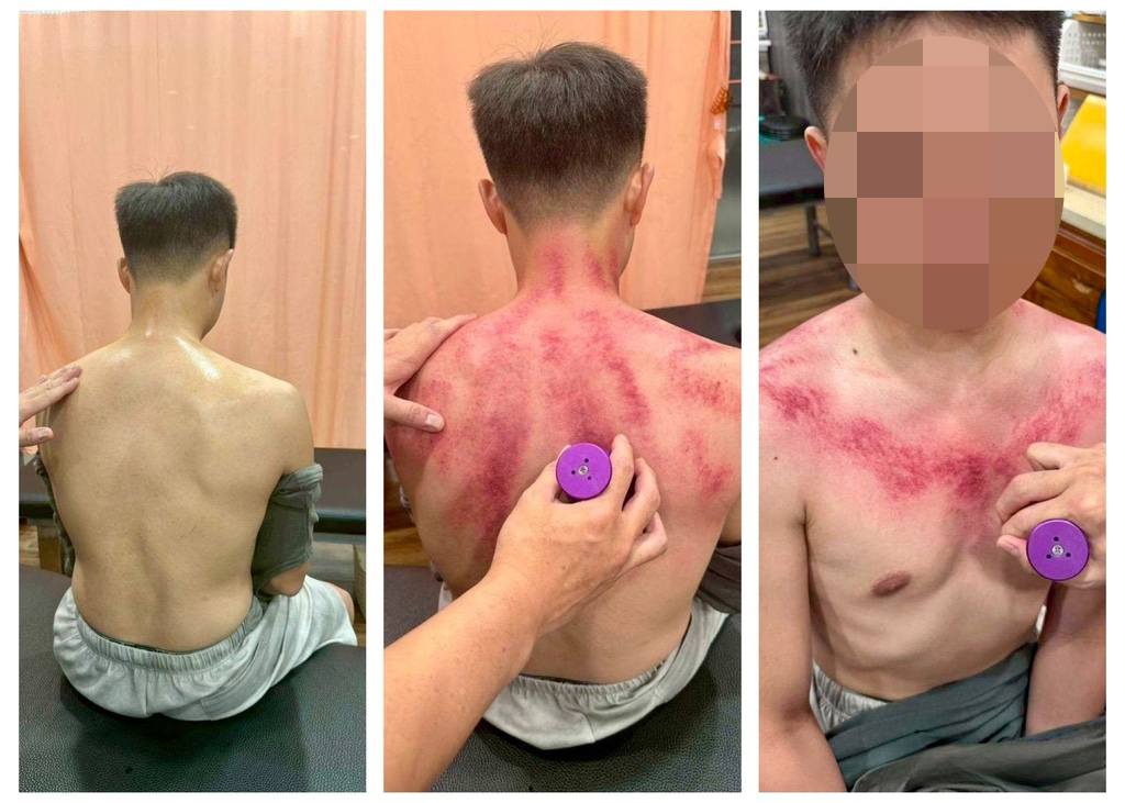 台南永康中醫｜親身體驗【健恩中醫診所】艾草溫罐療法｜解決肩頸
