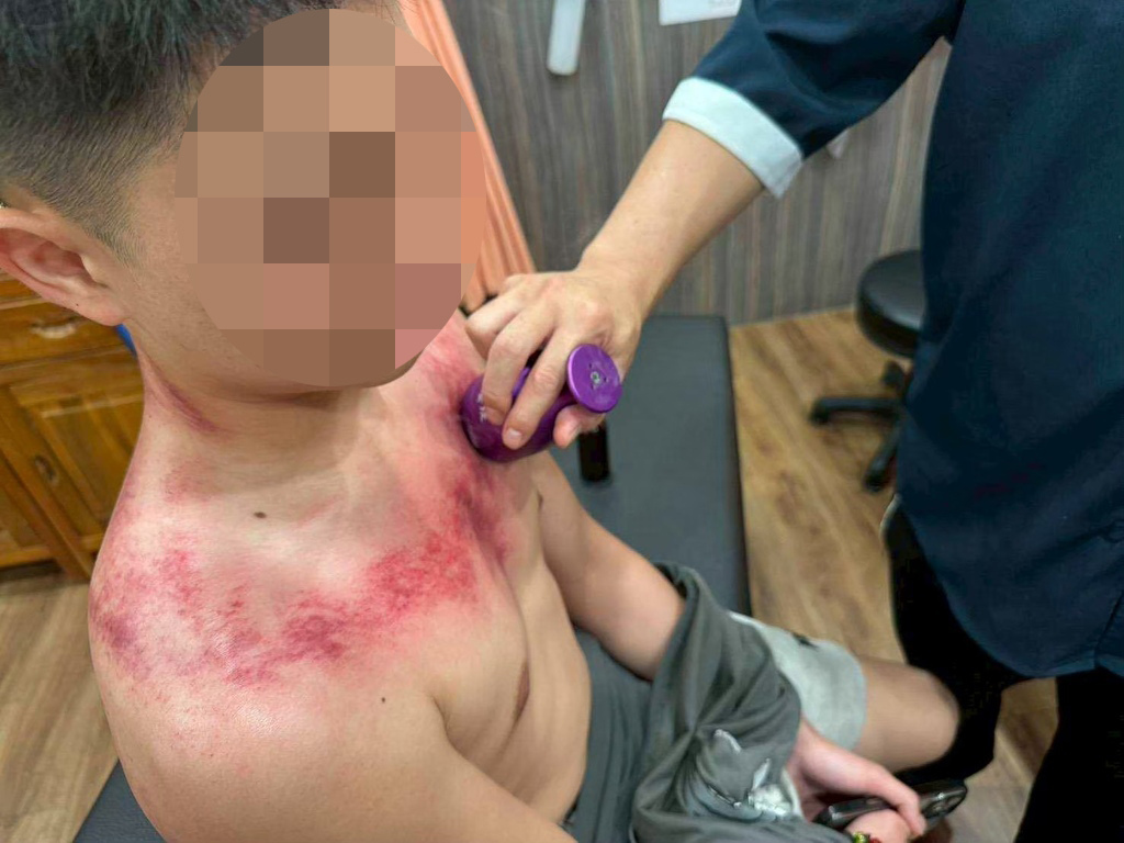 台南永康中醫｜親身體驗【健恩中醫診所】艾草溫罐療法｜解決肩頸