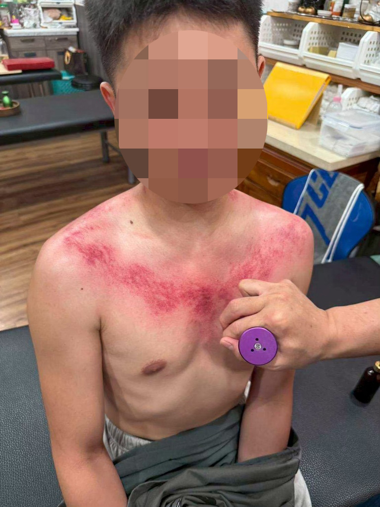 台南永康中醫｜親身體驗【健恩中醫診所】艾草溫罐療法｜解決肩頸