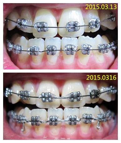 矯正 第21天 牙齒敏感最痛 Rita 瑞塔 痞客邦