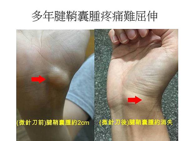 腱鞘囊腫.jpg