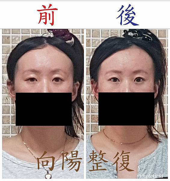 向陽美式整復中心·筋膜力學·筋膜滑移技術-（桃園整骨·中壢整