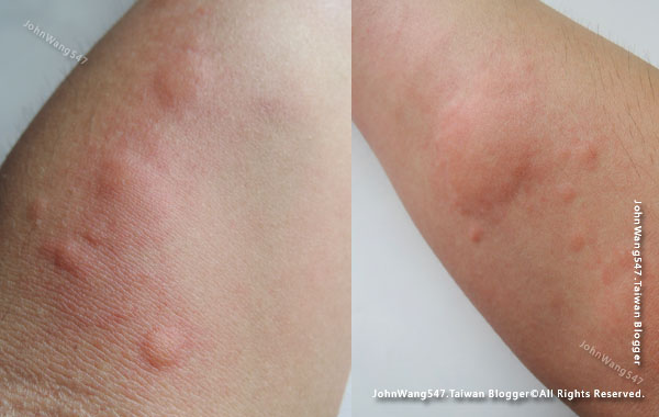 蕁麻疹 Hives(Urticaria)手臂.jpg