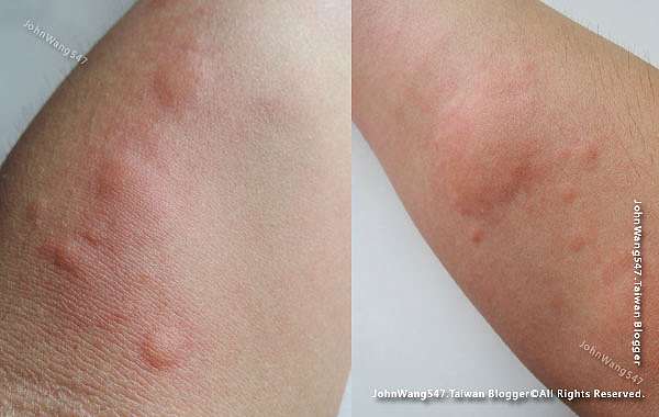 經驗談 認識蕁麻疹hives 找出誘因 避免惡化 蕁麻疹止癢藥膏與注意事項 小約翰就愛泰國自由行 痞客邦