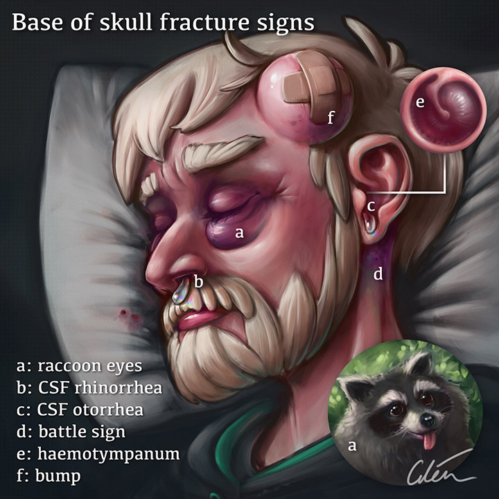 老愛急診初體驗 20210221_162600_base-of-skull-fracture-signs.jpeg