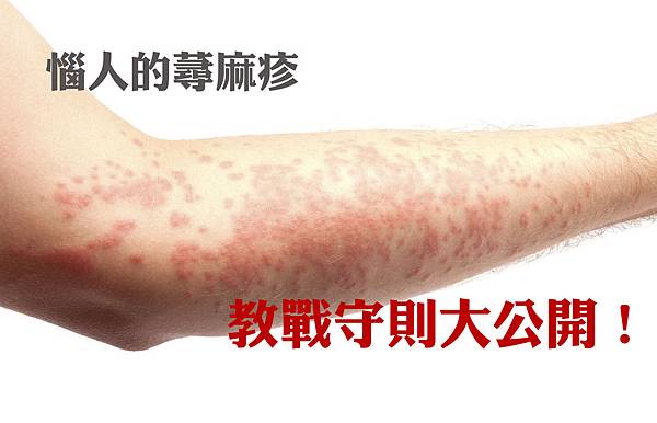 惱人的蕁麻疹.jpg 惱人的蕁麻疹.jpg