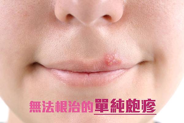 皰疹.jpg 皰疹.jpg