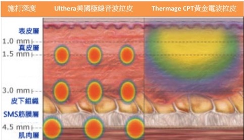 音波拉皮跟電波拉皮的區別 - 作用的深度跟覆蓋率