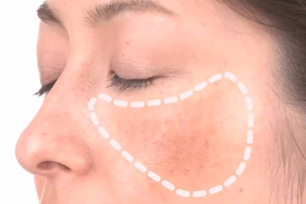 皮膚病症中難解的複雜斑 - 肝斑該如何治療？蔡佳芬醫師分享肝斑治療心得