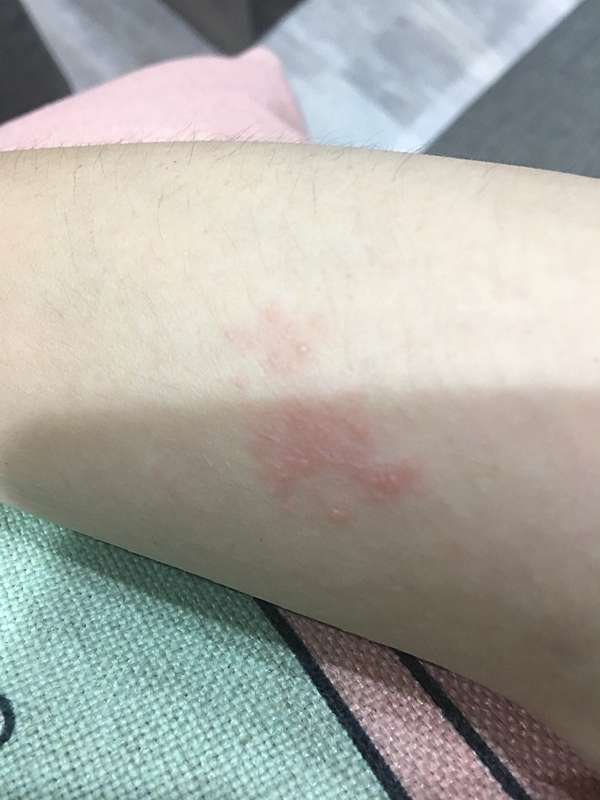 醫療保健 以為是神經壓迫後來才發現是帶狀疱疹 皮蛇 Jessie In The House 痞客邦 醫療保健 以為是神經壓迫後來才發現是帶狀疱疹 皮蛇 Jessie In The House 痞客邦