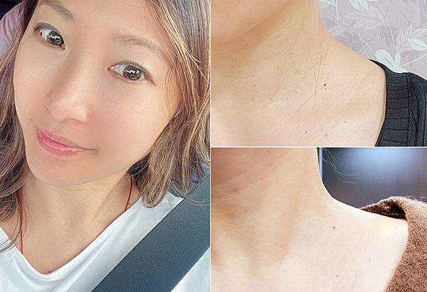 台北除疣推薦x除肉芽x小息肉x脖子除疣│鉺雅鉻雷射一次掃光四十多棵贅疣,告別髒脖子│旭彤診所-00.jpg