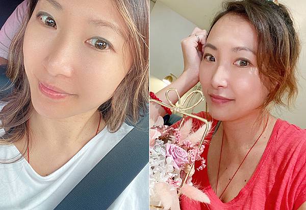 台北除疣推薦x除肉芽x小息肉x脖子除疣│鉺雅鉻雷射一次掃光四十多棵贅疣，告別髒脖子│旭彤診所-03.jpg