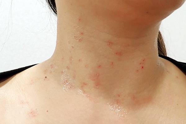 台北除疣推薦x除肉芽x小息肉x脖子除疣│鉺雅鉻雷射一次掃光四十多棵贅疣，告別髒脖子│旭彤診所-22.JPG