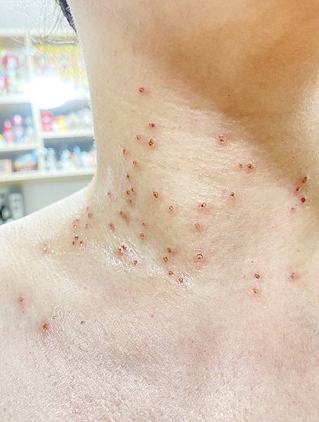 台北除疣推薦x除肉芽x小息肉x脖子除疣│鉺雅鉻雷射一次掃光四十多棵贅疣,告別髒脖子│旭彤診所-28.jpg