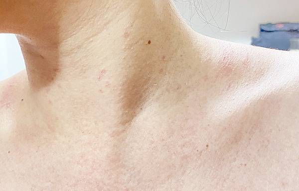 台北除疣推薦x除肉芽x小息肉x脖子除疣│鉺雅鉻雷射一次掃光四十多棵贅疣,告別髒脖子│旭彤診所-32.jpg