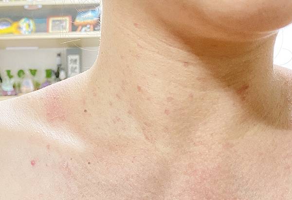 台北除疣推薦x除肉芽x小息肉x脖子除疣│鉺雅鉻雷射一次掃光四十多棵贅疣，告別髒脖子│旭彤診所-33.jpg