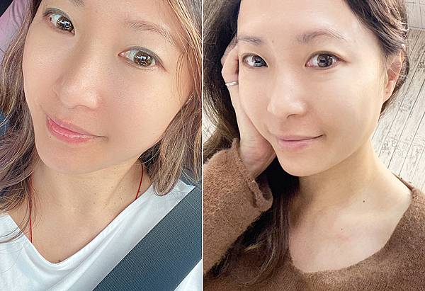 台北除疣推薦x除肉芽x小息肉x脖子除疣│鉺雅鉻雷射一次掃光四十多棵贅疣，告別髒脖子│旭彤診所-36.jpg