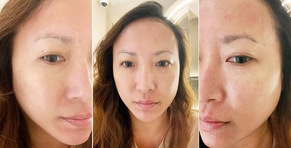 台北打雷射推薦|RedTouch PRO凍態雷射分享│台北東區醫美診所,羅峙錕醫師率領,僅接受預約制的綻妍診所-33.jpg