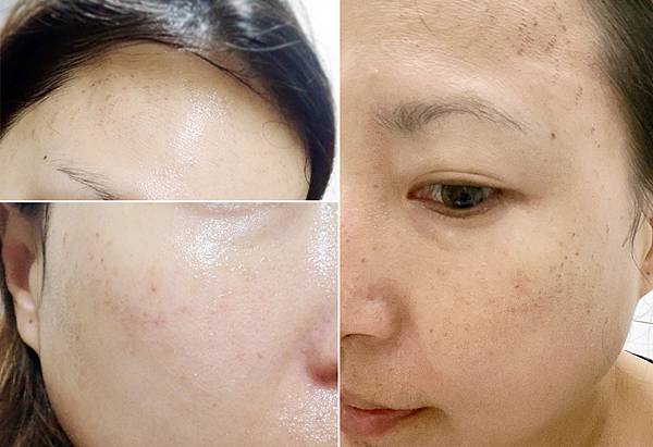 台北打雷射推薦｜RedTouch PRO凍態雷射分享│台北東區醫美診所，羅峙錕醫師率領，僅接受預約制的綻妍診所-35.jpg