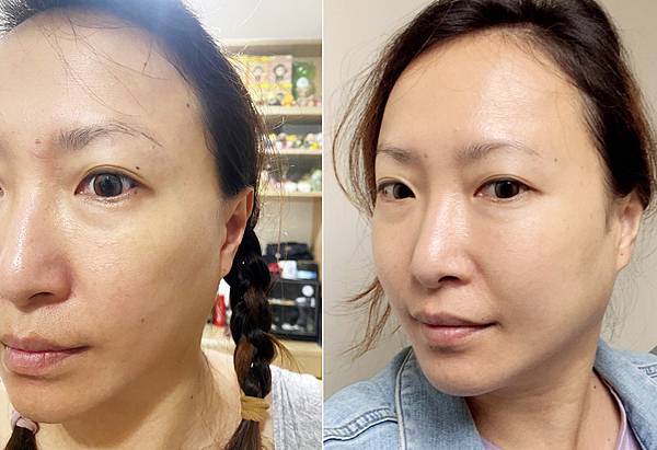 台北打雷射推薦|RedTouch PRO凍態雷射分享│台北東區醫美診所,羅峙錕醫師率領,僅接受預約制的綻妍診所-43.jpg