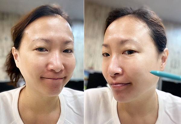 台北打雷射推薦｜RedTouch PRO凍態雷射分享│台北東區醫美診所，羅峙錕醫師率領，僅接受預約制的綻妍診所-44.jpg