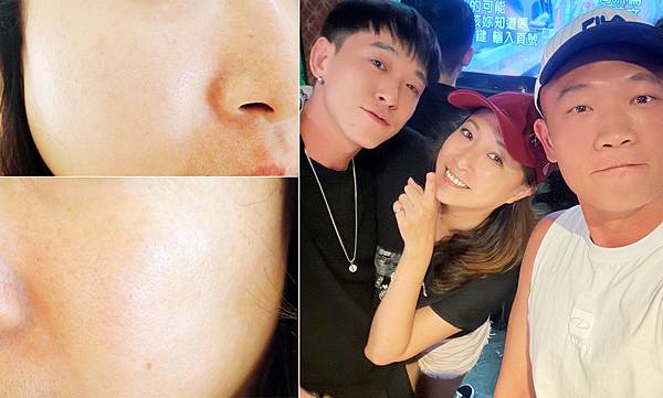 台北打雷射推薦|RedTouch PRO凍態雷射分享│台北東區醫美診所,羅峙錕醫師率領,僅接受預約制的綻妍診所-45.jpg