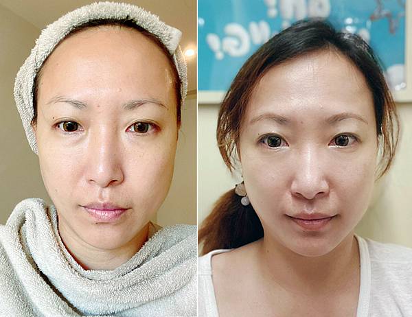 台北東區打雷射|RedTouch PRO凍態雷射(果凍光)療