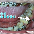 側骨釘