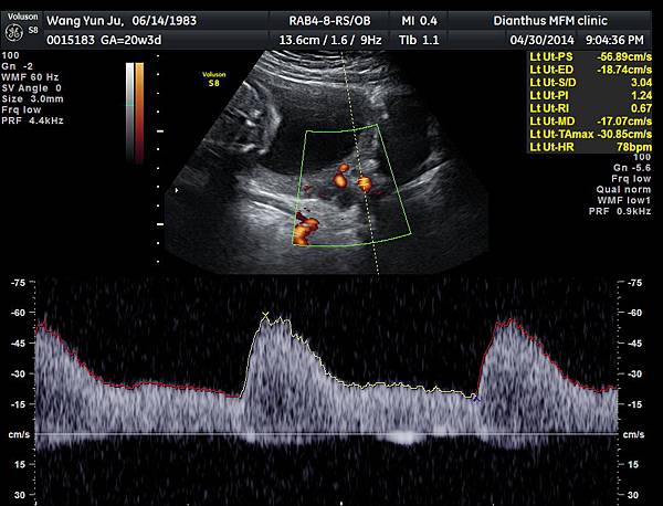 20w3d子宮動脈血流阻力左側1.24
